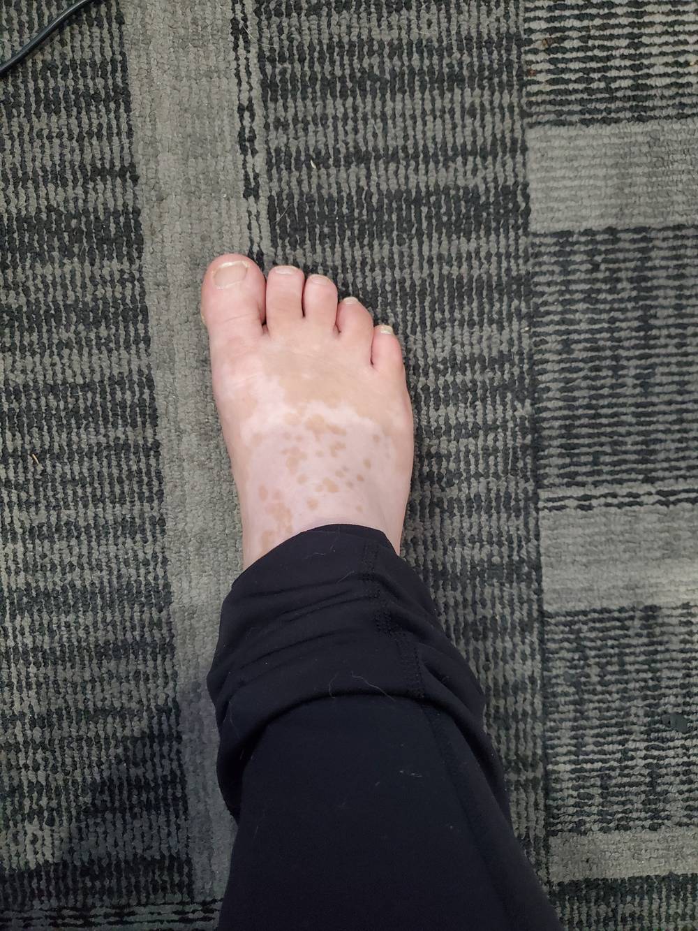 Vitiligo Feet